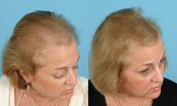 Effective Treatment For Hair Loss
