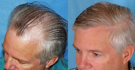 The Most Effective Treatment for Hair Loss - Health & Beauty Services Baton Rouge & Covington